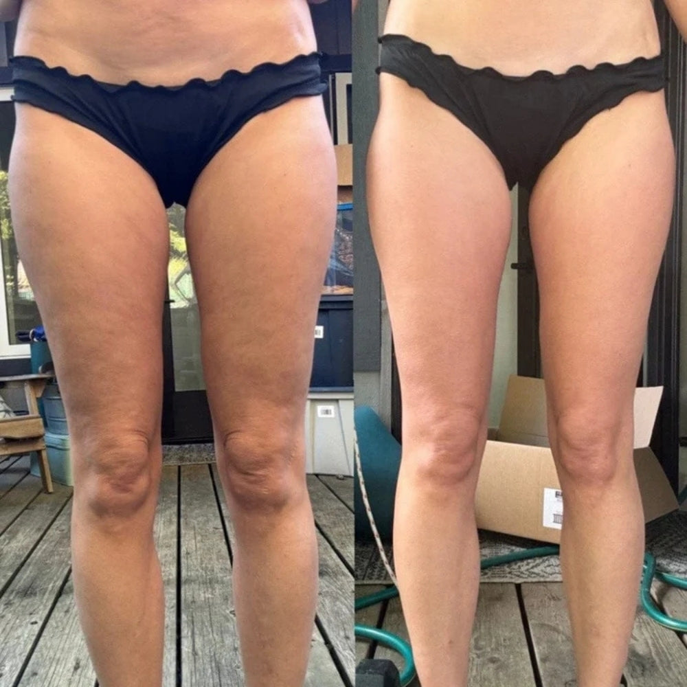 Obellex™ - Anti-Cellulite Massager